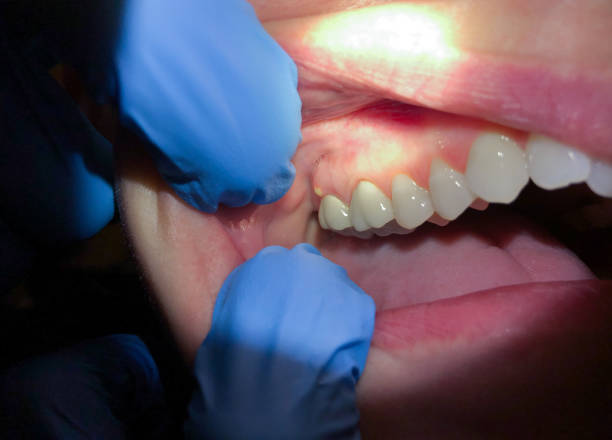 Best Emergency Dental Care for Sports Injuries in Kensington, NY